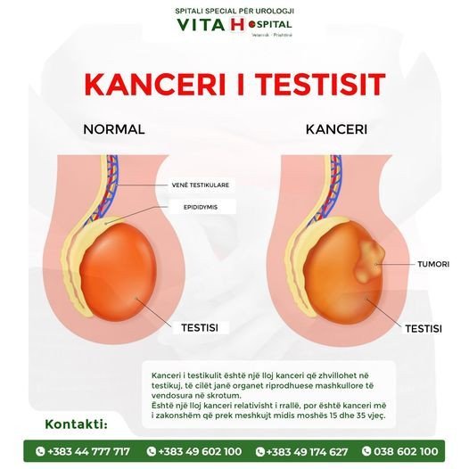 Kanceri i testikulit