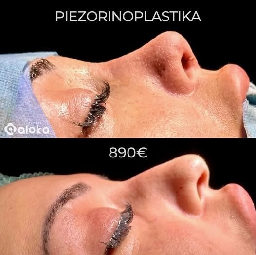 Rinoplastikë