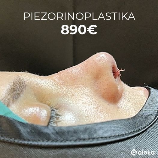 Piezorinoplastika