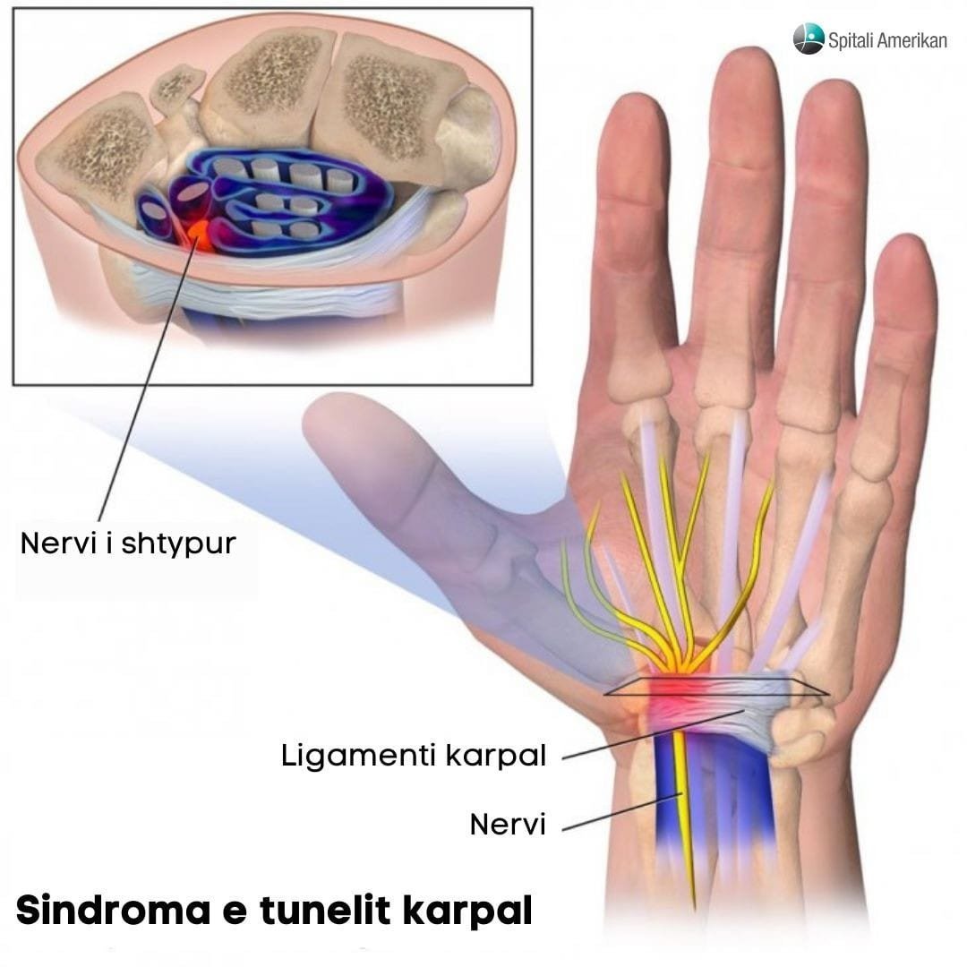 Sindroma e tunelit Karpal