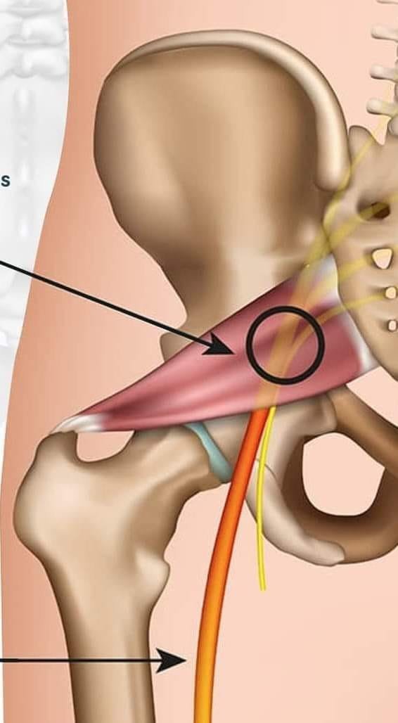 SINDROMA PIRIFORMIS