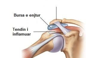 Cfarë është Bursitis?