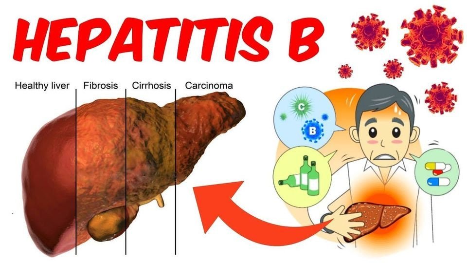 Hepatiti B  (HBV-DNA)