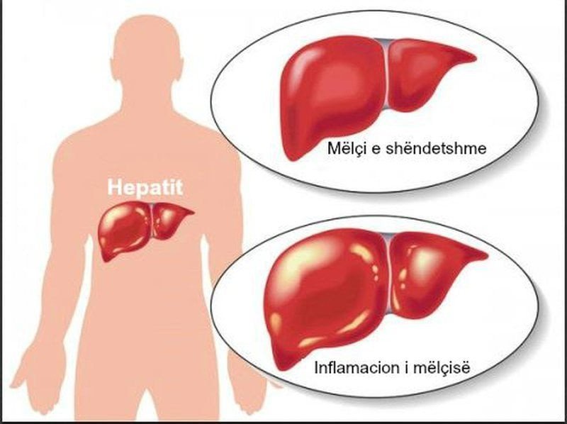 Pse është i rëndësishëm testimi sasior i HCV-RNA-së ?