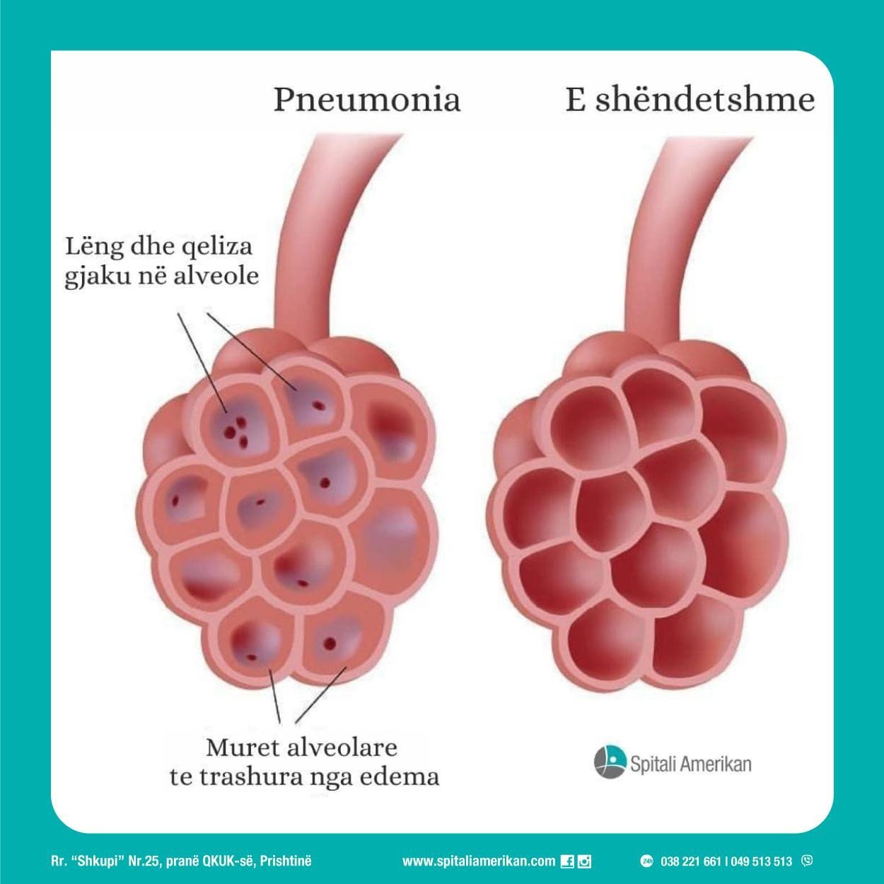 Pneumonia