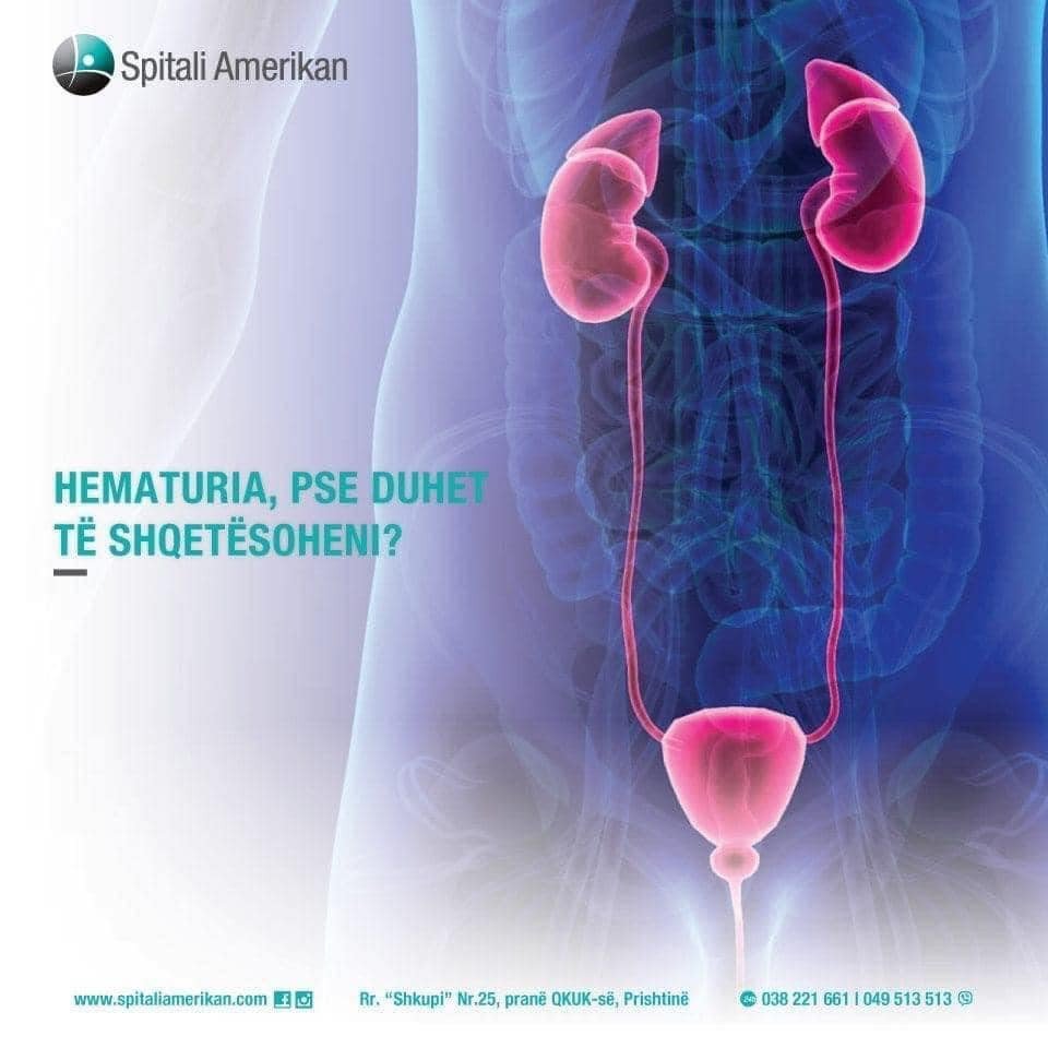 HEMATURIA OSE GJAKU NË URINË PËRSE DUHET TË SHQETËSOHENI?