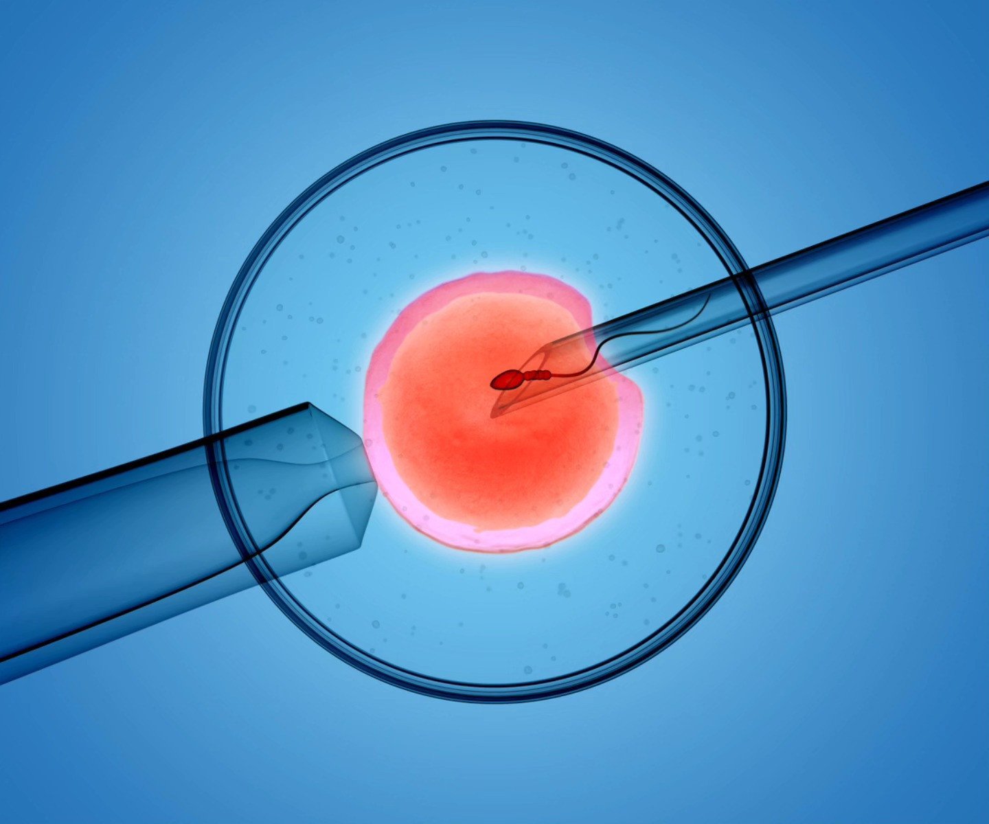 IVF (In Vitro Fertilization)