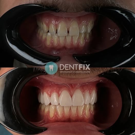 Veneers Smile