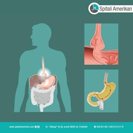 HERNIA HIATALE