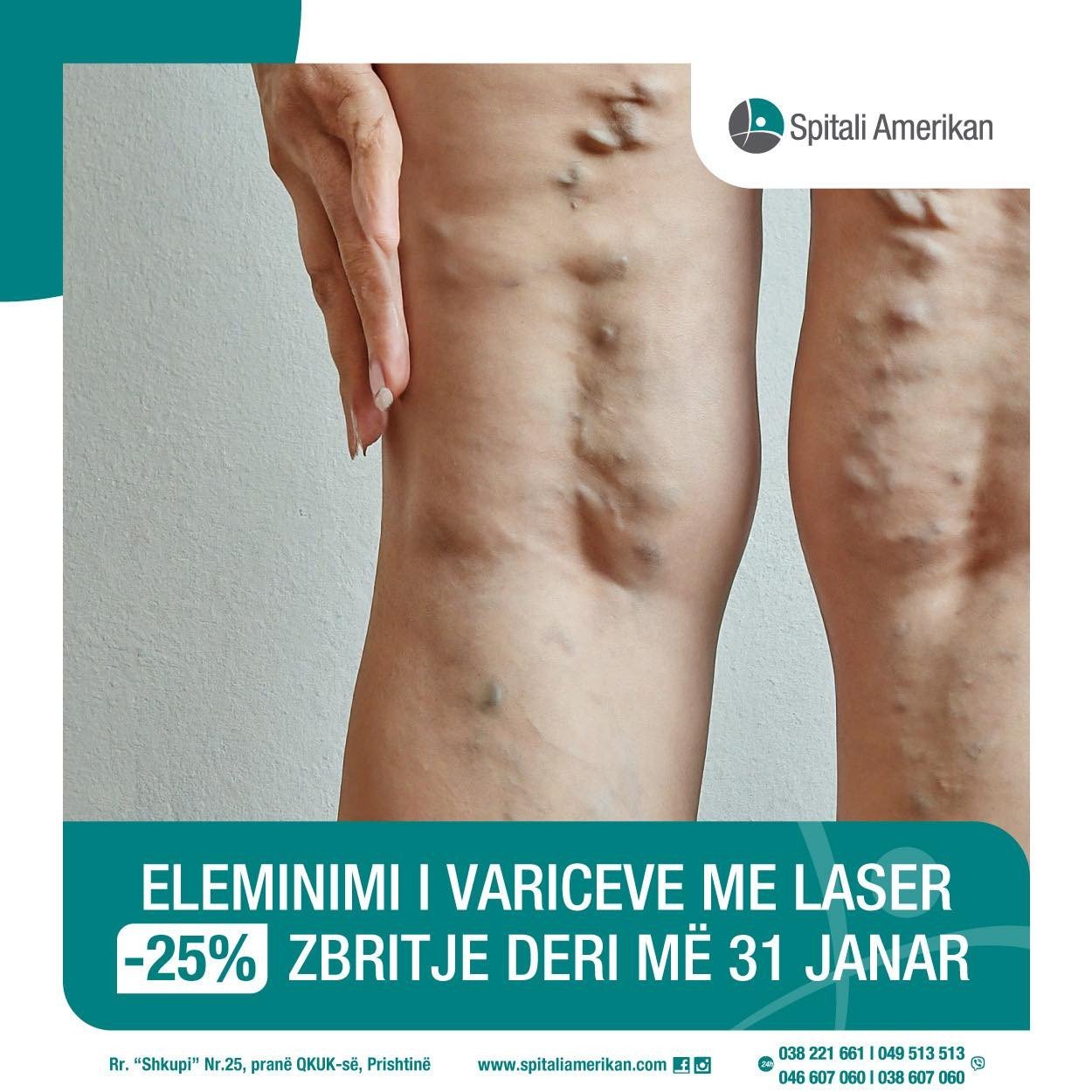 Eleminimi i Variceve me Laser