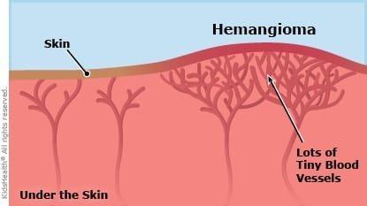 Krem per hemangiome, Shurup per hemangiome