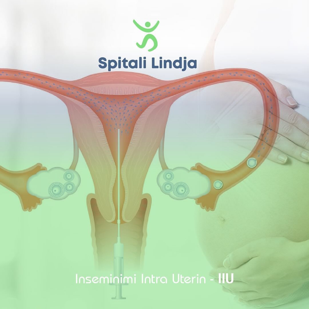 Inseminimi Intrauterin (IIU)