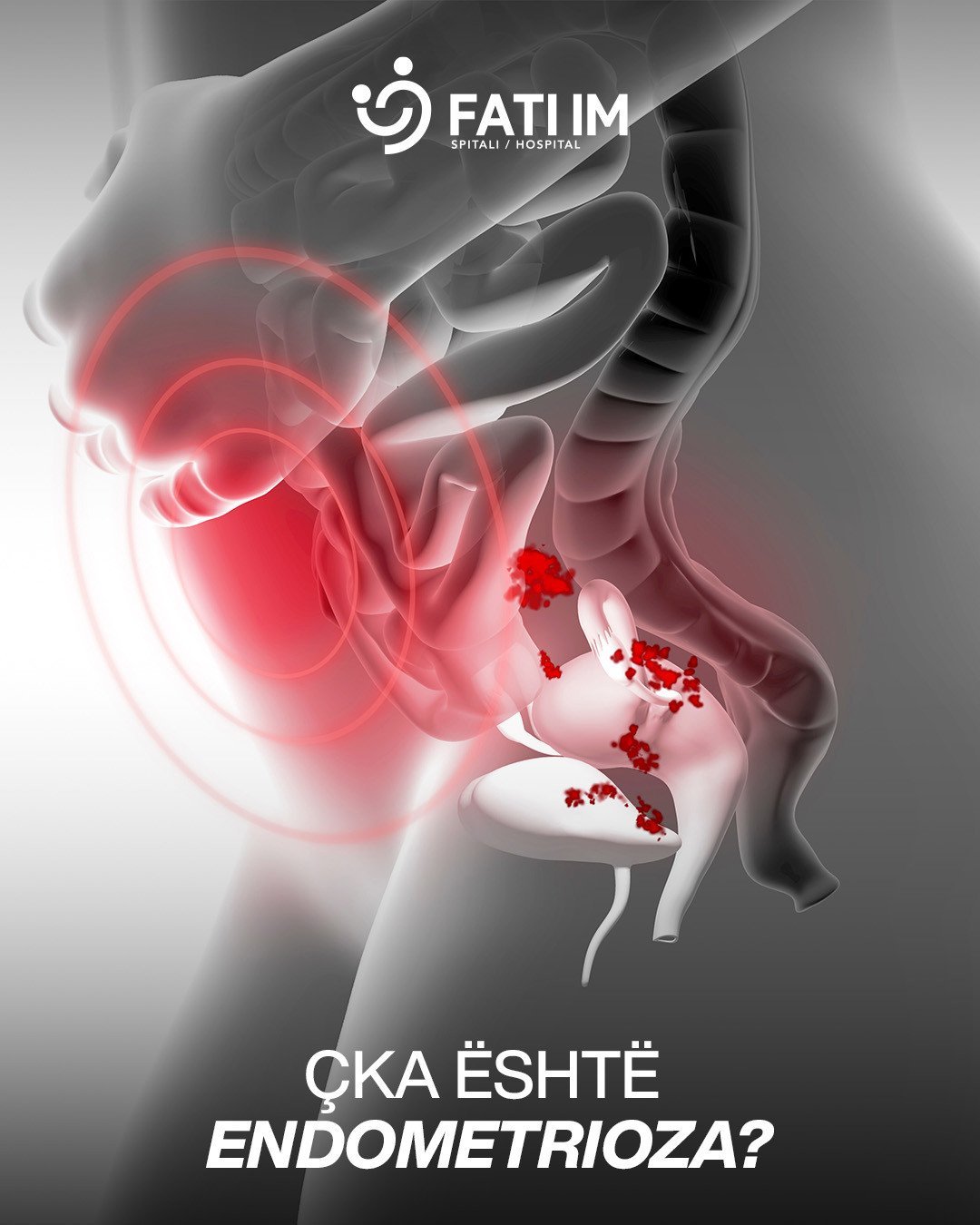 ÇKA ËSHTË ENDOMETRIOZA ?
