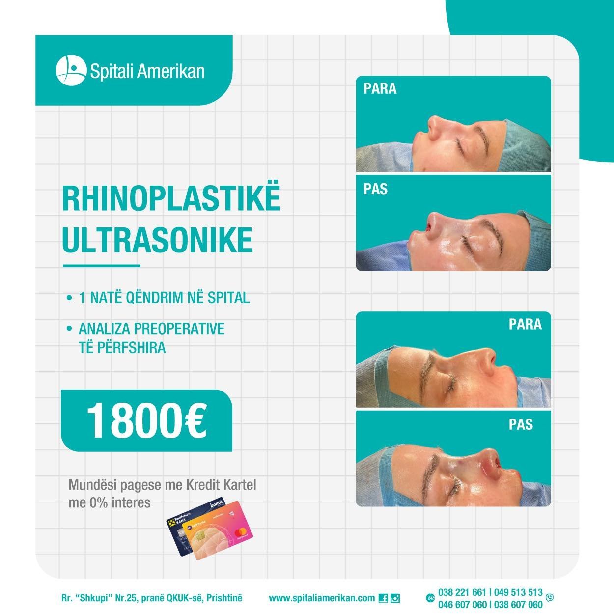 RHINOPLASTIKË ULTRASONIKE – ÇMIM PROMOCIONAL: 1800 EURO