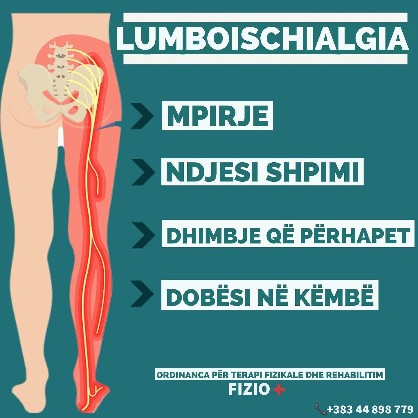 Çfarë është lumboischialgjia?