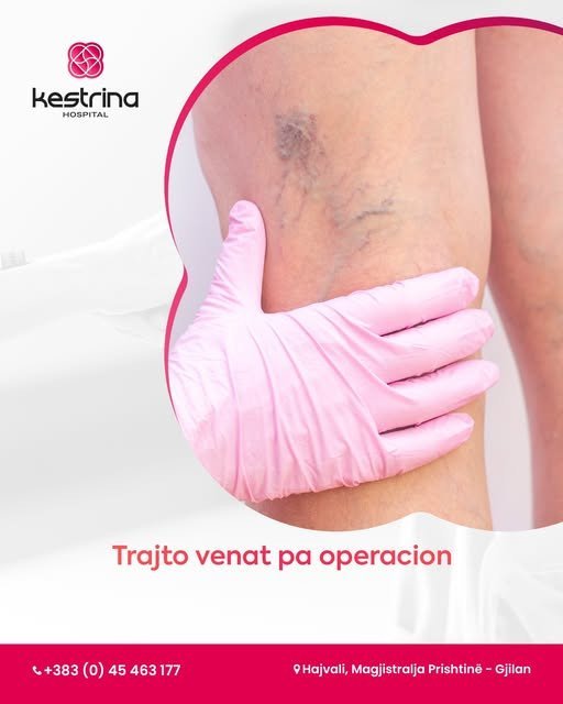 Vena të fryra? Këmbë të rënda?