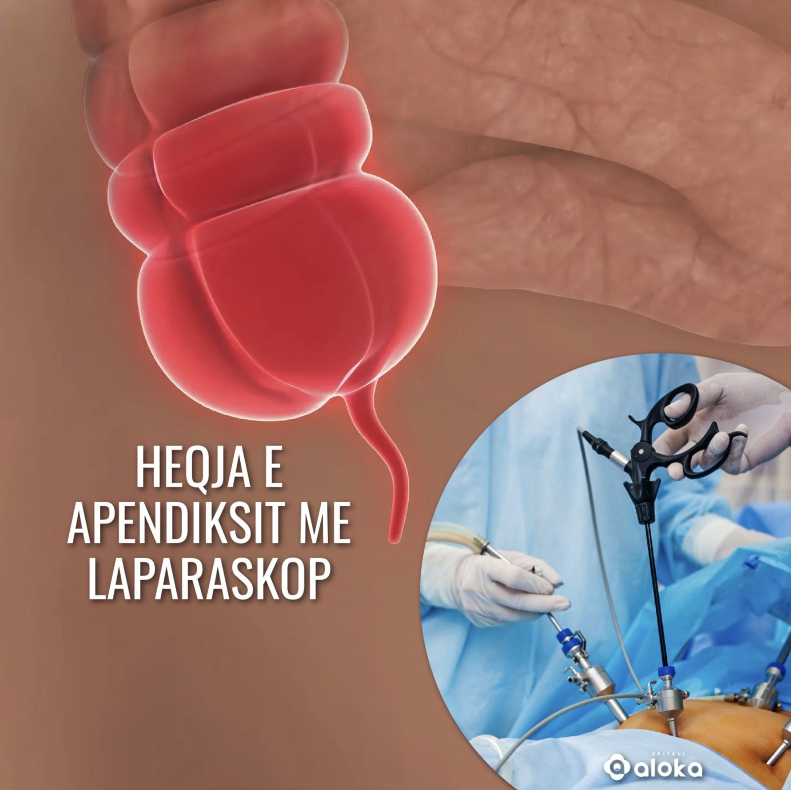 Heqja e apendiksit (zorrës qorre) me laparoskopi