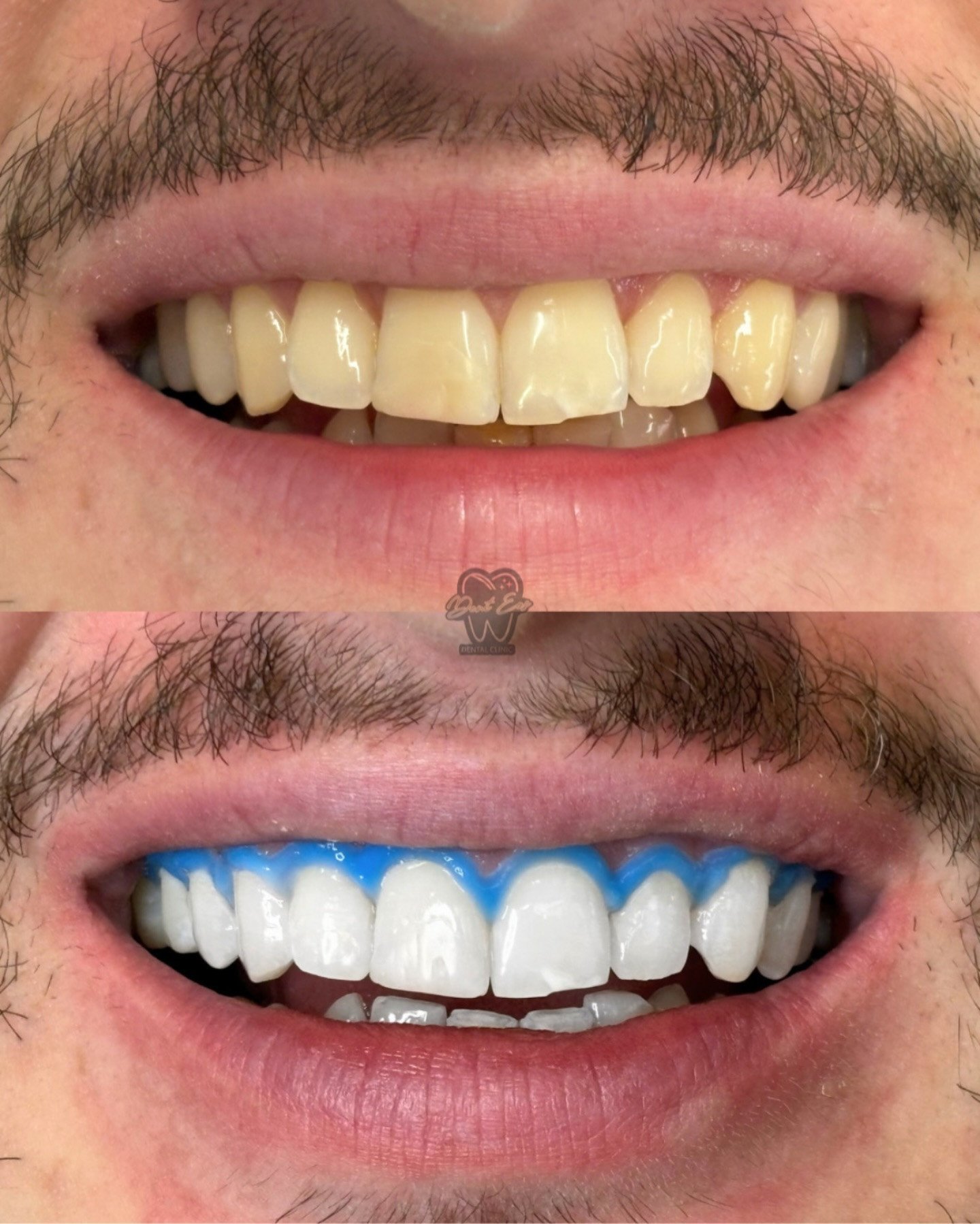 Zbardhimi profesional i dhëmbëve