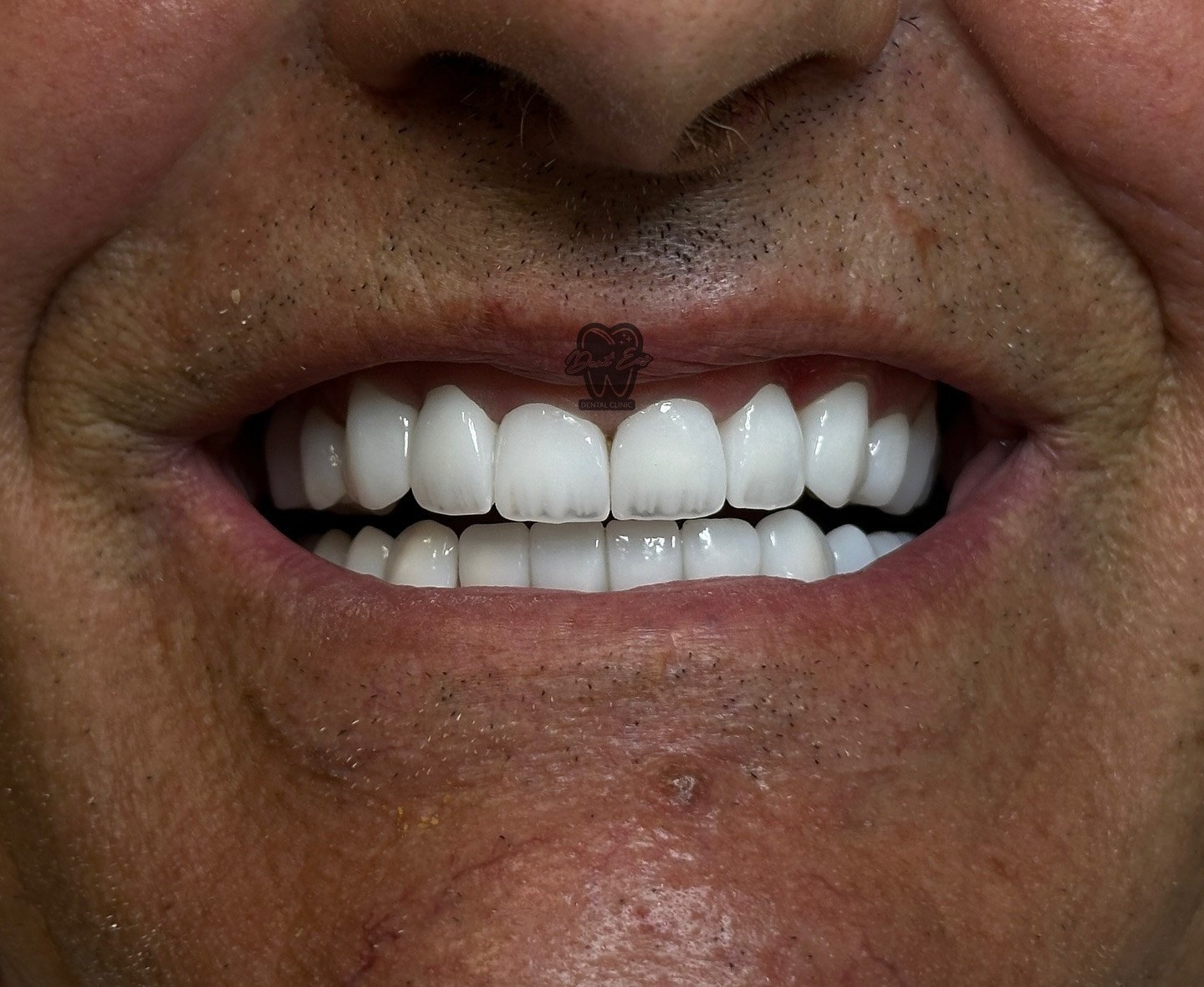 Rehabilitimi i dy nofullave me kurora zirkoni