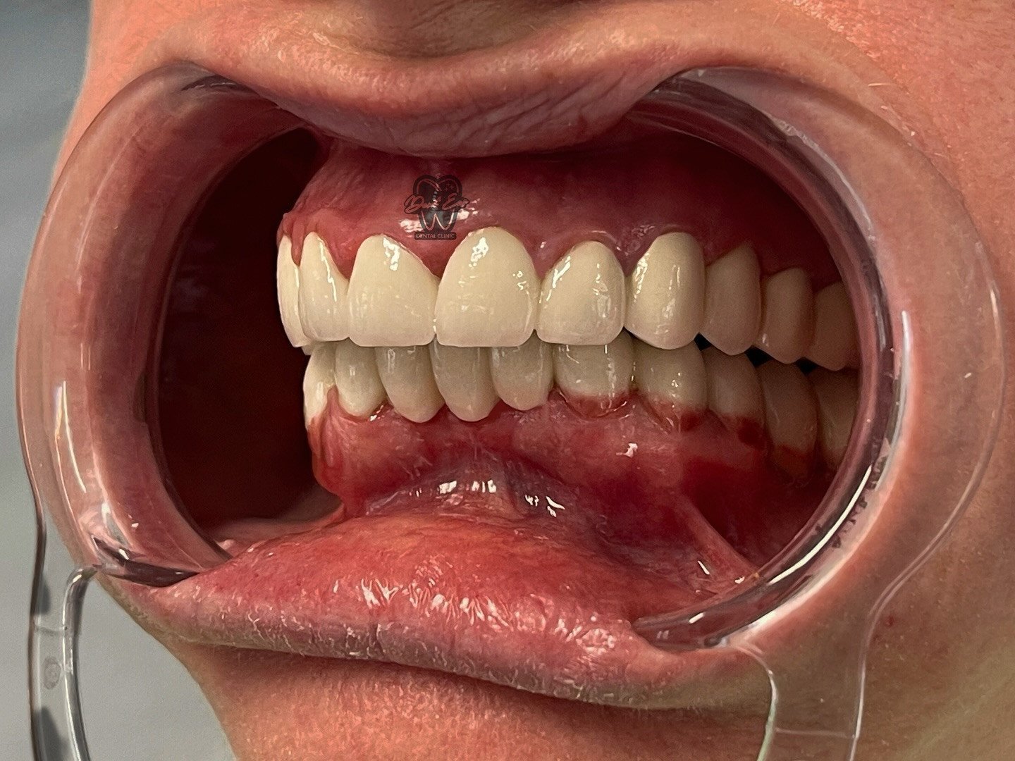 Rehabilitimi i të dy nofullave me kurora nga metal-porcelani