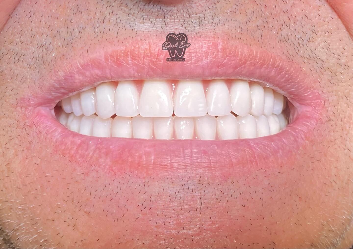 Arrihet rehabilitimi i dy nofullave me protezë totale