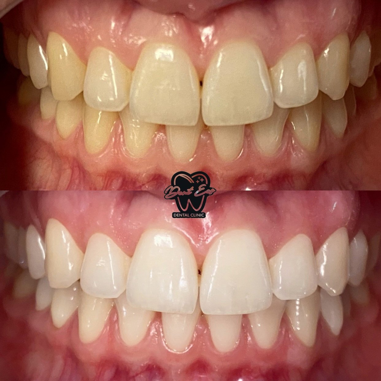 Zbardhimi i dhëmbëve me laser