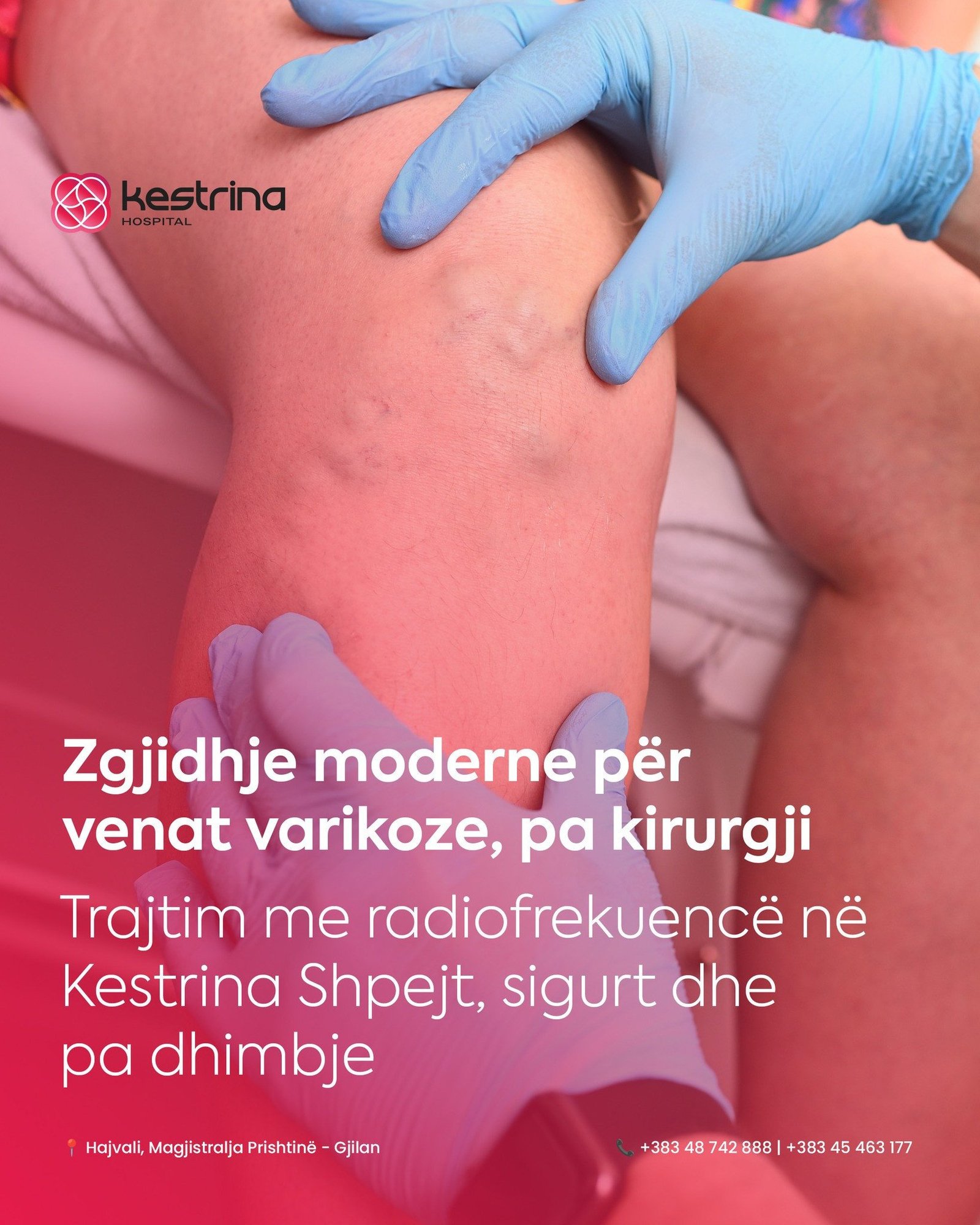 Venat e zgjeruara në këmbë? Dhimbje dhe ndjesi rëndese që përkeqësohen gjatë ditës?