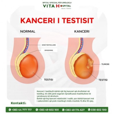VITA Hospital- Kanceri i testikulit
